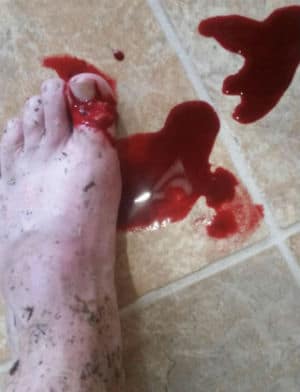 Pressure Washer Safety Tips For Beginners Bloody Big Toe Injury from Pressure Washing