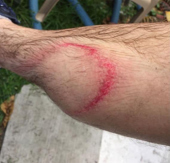 Pressure Washer Safety Tips For Beginners Pressure Washing Injury To Skin Laceration
